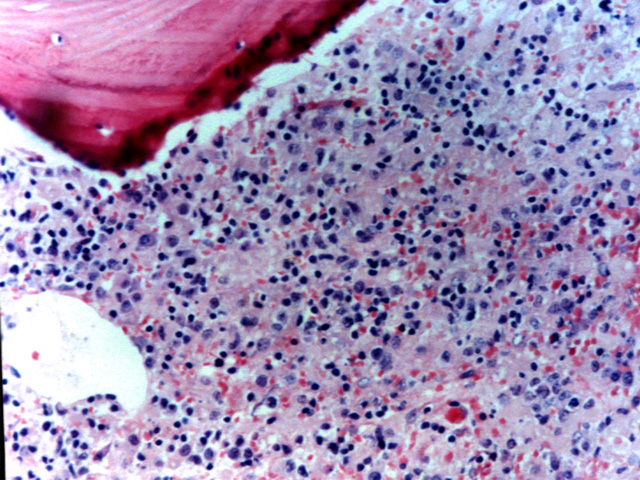 Fig. 27: Leucemia Agresiva de clulas NK. - <div style=